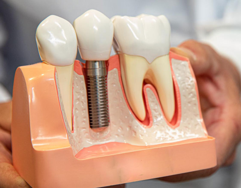 Dental Implant Restorations | Waterford, CT