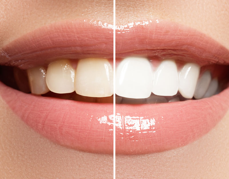 teeth whitening before and after Waterford, CT